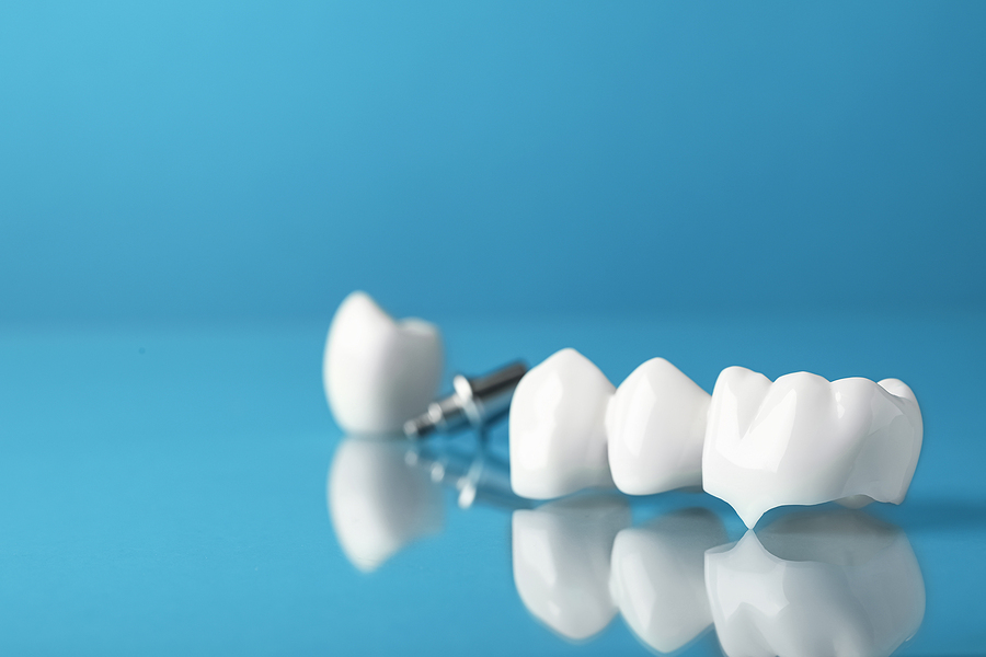 Everything You Need to Know About Dental Crowns: A Complete Guide by All Smiles Family Dentistry