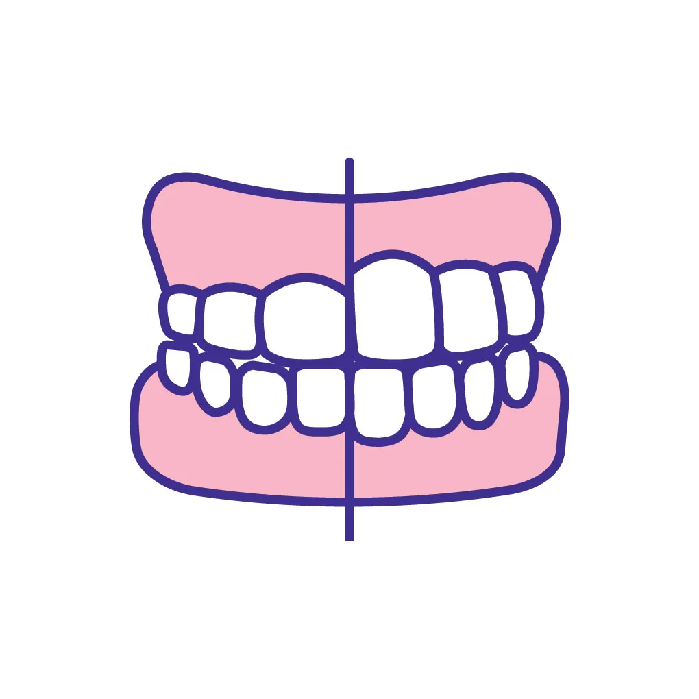 Dental Veneers